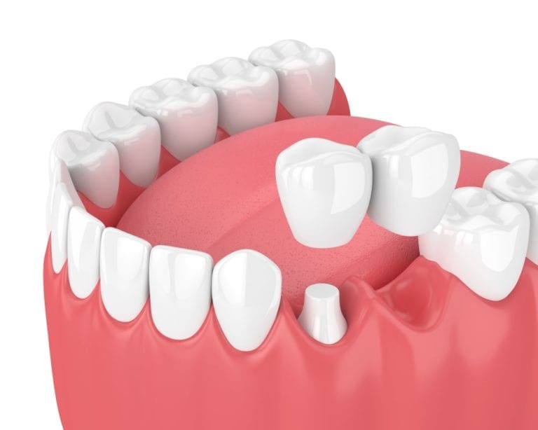 4 Types Of Dental Bridges - Laurich Dentistry