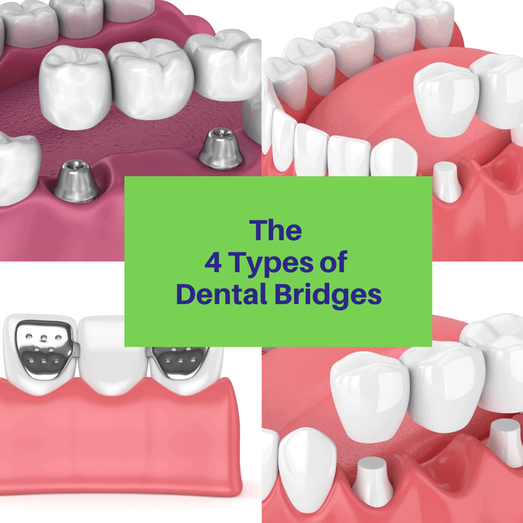 Types Of Dental Bridges