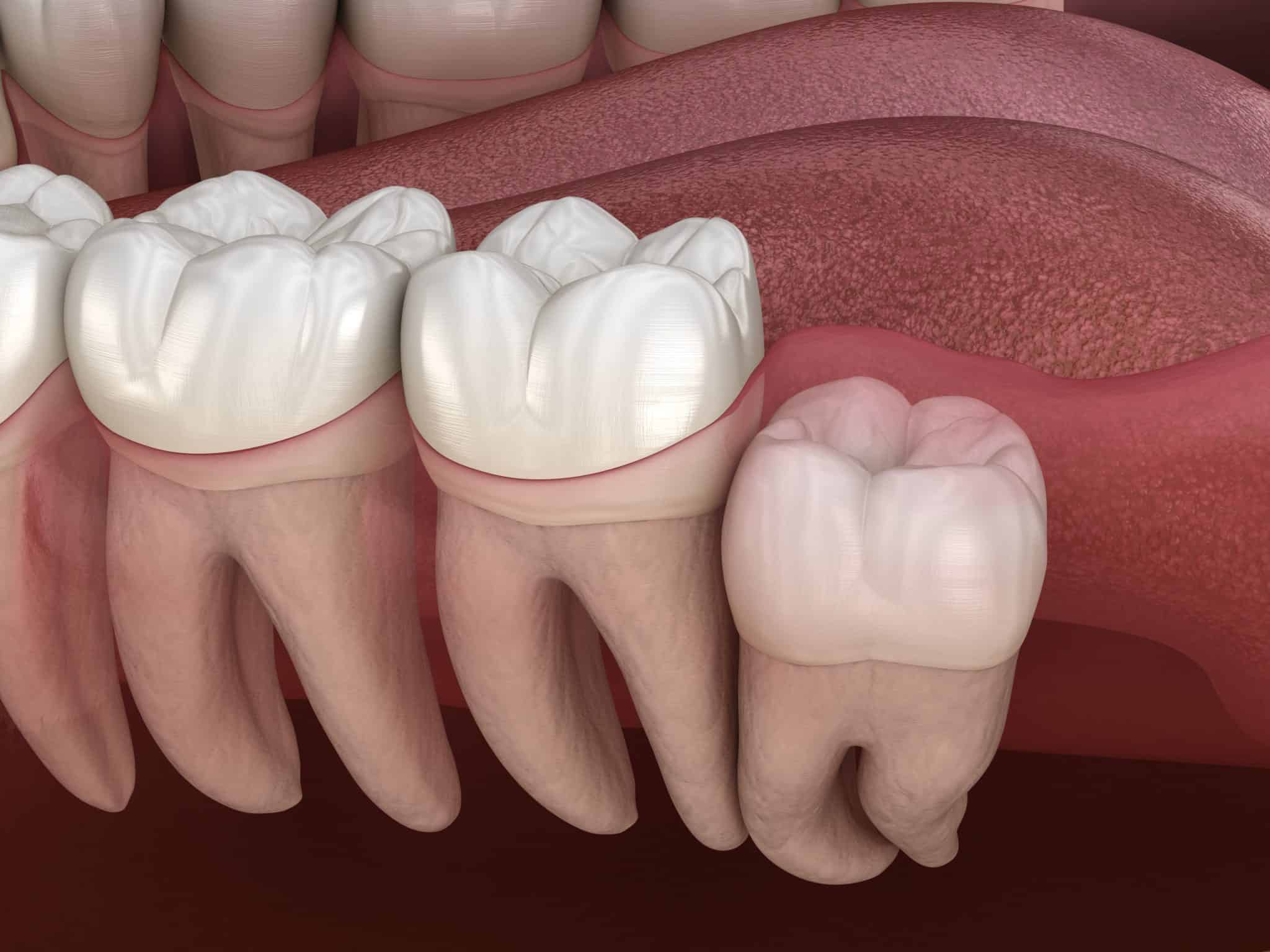 4 Types Of Wisdom Teeth Impactions Laurich Dentistry 6375