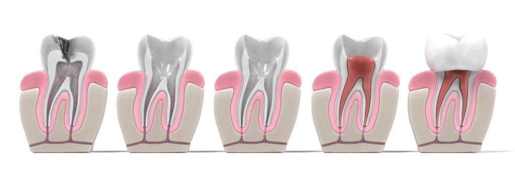 Root Canal Treatment Step by Step Graphic